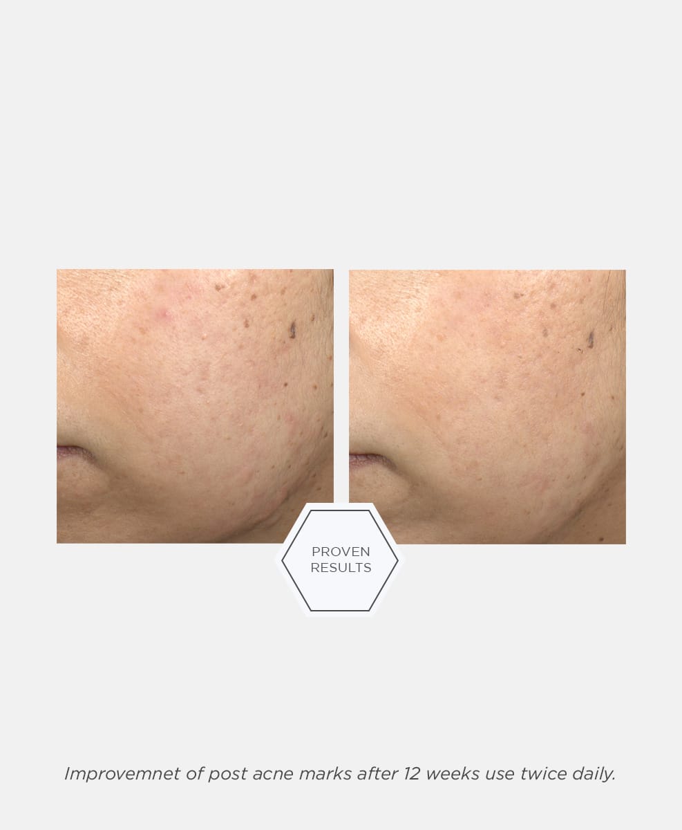 Post-Acne Mark Correcting Serum